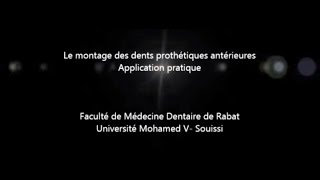 Montage des dents prothétiques antérieures [upl. by Suiratnod]