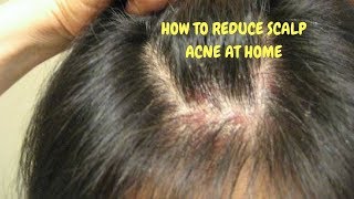 HOW TO REDUCE SCALP ACNE AT HOME [upl. by Heidy406]