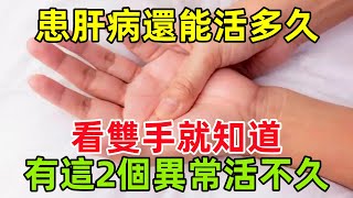 患肝病後還能活多久，看雙手就知道？雙手有這2個異常，活不久？健康常識養生保健健康健康飲食 [upl. by Fretwell297]