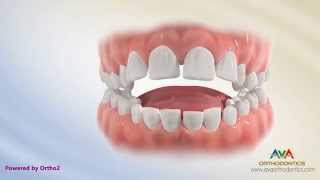 Orthodontic Treatment for Tongue Thrusting Habit  Different Options [upl. by Efi]