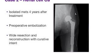 Bone Metastasis  ABOS Orthopedic Surgery Board Exam Review [upl. by Andie827]