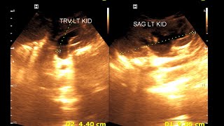 Bilateral hydro nephrosis  Bilateral dilated ureter  Renal Ultrasonography [upl. by Nalla940]