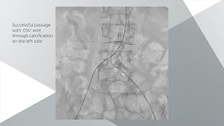 Next Generation Case Study Video RESTORING FLOW TO PATIENT WITH STENOSIS AT AORTOILIAC BIFURCATION [upl. by Meriel]