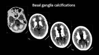 Radiology  Imaging of Intracranial Calcifications  Brain [upl. by Jonette114]