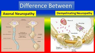 Different between Axonal Neuropathy and Demyelinating Neuropathy [upl. by Kiker]