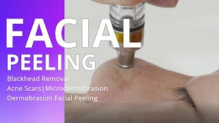 Blackhead Removal  Acne Scars  Microdermabrasion Dermabrasion Facial Peeling [upl. by Serrano]