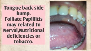 Tongue back side bumpFolliate Papillitis may related to NervalNutritional deficiencies or tobacco [upl. by Selim]