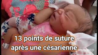 13 points de suture au visage après une césarienne 😲😲 [upl. by Colman536]