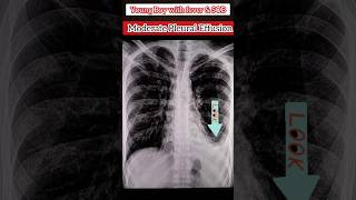 Pleural Effusion on XRay Chest 🩻 medical xray diagnosis radiology ultrasound shorts [upl. by Harcourt]