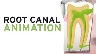 Root Canal Treatment RCT Step by Step Animation [upl. by Atileda]