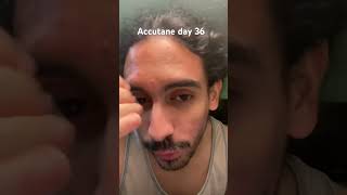 Accutane day 36 acne accutane acnetreatment [upl. by Eralc]