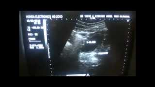 ultrasound Medullary sponge kidneys CLPD THYROID COMPLEX CYST  4 of 7 [upl. by Atinniuq]