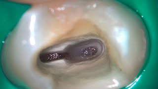 DRendo  Deep partial pulpotomy in a maxillary premolar [upl. by Kira]