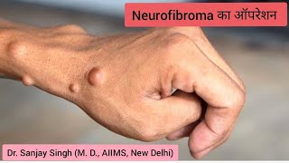 Excision of Neurofibroma under local anaesthesia Neurofibroma Neurofibromatosis lipomatreatment [upl. by Sidman]