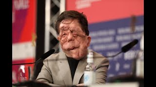 Adam Pearson Entstellter BerlinaleStar begeistert bei Premiere [upl. by Ortrude143]