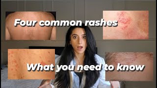 Four common rashes and everything you need to know about them [upl. by Gwenny]