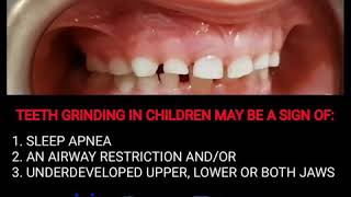 Causes of teeth grinding in Kids amp Children  Sleep Apnea  TMJ Disorder  Narrow Jaw Bioblock ALF [upl. by Ulda]