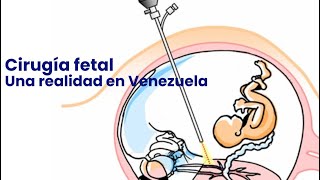 Cirugía fetal Una realidad en Venezuela [upl. by Aerehs]