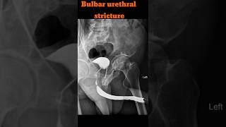 RGU  Retrograde urethrogram  Bulbar urethral stricture shorts rgu radiology specialcase [upl. by Durware232]