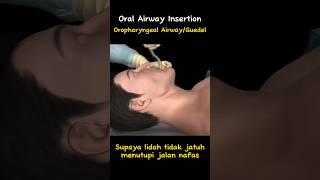 Oropharyngeal Airway [upl. by Azirb]