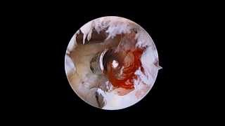 Elbow Arthroscopy  Osteoarthritis  Nicky Leung MD [upl. by Yror]