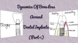 Dynamics of Bone Loss around Dental Implants Part1Microgap between Implant Components [upl. by Aisiat995]