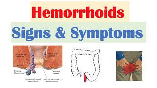 Hemorrhoids Signs amp Symptoms  Internal vs External Hemorrhoid Symptoms  Hemorrhoidal Disease [upl. by Hedda]