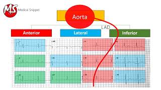 ECG localisation of the occluded coronary artery Myocardial Infarction [upl. by Ayocat]