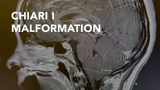 Chiari I Malformation Decompression Surgery [upl. by Lichtenfeld]