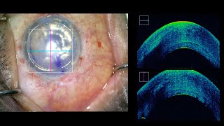 Descemet Stripping Automated Endothelial Keratoplasty DSAEK [upl. by Nohtahoj]