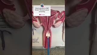 PAP Smear demonstration for Cervical cancer screening MEDICAL TIPS [upl. by Etteoj]