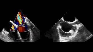 Evaluation of rheumatic mitral stenosis with transesophageal echocardiography [upl. by Ahsaret]