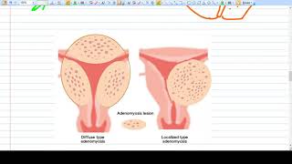 Adenomyosis  Concept  Diagnosis Management [upl. by Koren]