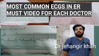 SIX TIPS FOR HOW TO READ AN ECGNORMAL VS ABNORMAL ECG ecgecginterpretationekgheartattackMI [upl. by Jacobo]