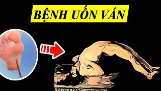 Tìm hiểu Bệnh Uốn ván cực kỳ Nguy hiểm trong 5 phút [upl. by Ahseinod73]