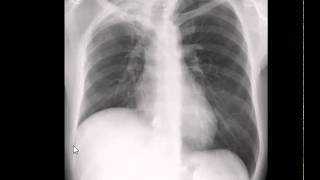 Chest xray interpretation Lung volume [upl. by Higginson23]