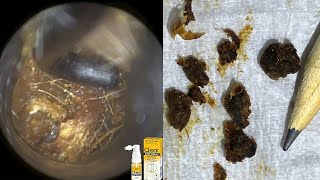 86  Completely Blocked amp Impacted Ear Wax Removal with WAXscope®️ [upl. by Kurtz300]