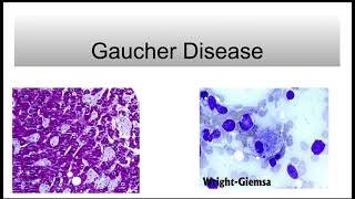 Gaucher Disease [upl. by Daahsar65]