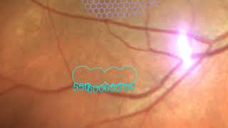 Navilas®  Navigated subthreshold retinal laser treatment with microsecond pulsing [upl. by Neville]