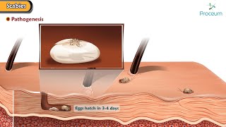 Scabies Predisposing factors Pathogenesis Types Clinical features Diagnosis Treatment [upl. by Akinihs]