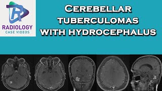 Cerebellar tuberculomas with hydrocephalus [upl. by Nadnerb]