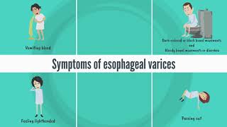 Patient education Esophageal varices The Basics [upl. by Lepper31]