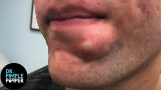 SATISFYING Dr Lee Pops Inflamed Cyst on Chin  Dr Pimple Popper Reacts [upl. by Sew]