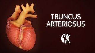 Truncus Arteriosus [upl. by Mcclure]