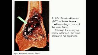 Giant cell tumor of bone and Metastatic disease [upl. by Nigel]