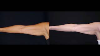 Remove Arm Flab with CoolSculpting [upl. by Asyal]