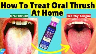 How To Treat Oral Thrush At Home  How to Treat Candida at Home [upl. by Idnor]