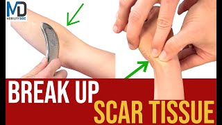 How To Break Up Scar Tissue  6 Effective Methods [upl. by Pish365]