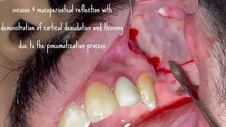 Maxillary sinus enucleation by Dr Nyer Firdoose [upl. by Robbert647]