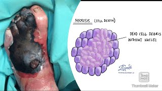 Necrosis and its types coagulative liquefactive caseous fat fibrinoid necrosis fmge neetpg [upl. by Blalock793]